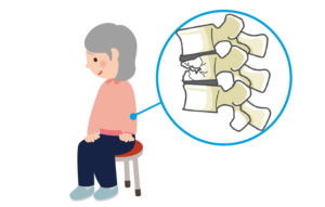 骨粗しょう症の骨折