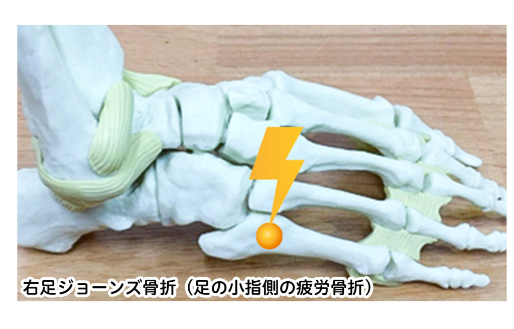 ジョーンズ骨折とは、足の小指の付け根を疲労骨折した状態