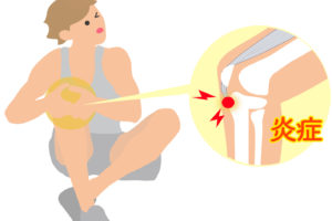 オスグッド・シュラッター病