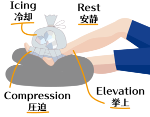 捻挫のときはRICE処置