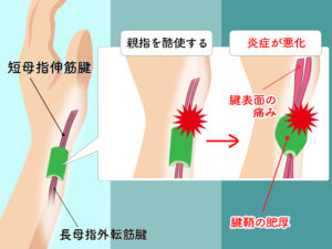 腱鞘炎とは