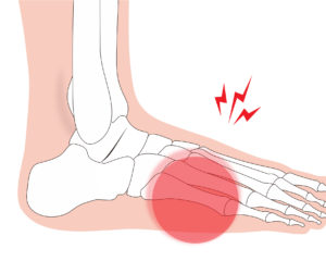 疲労骨折が起こりやすい部位