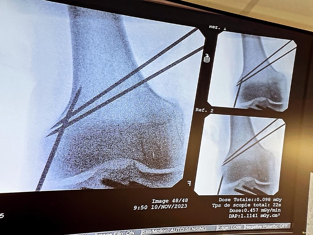 ESSKA主催の膝関節周囲骨切り術の認定医試験に大西医師が参加しました